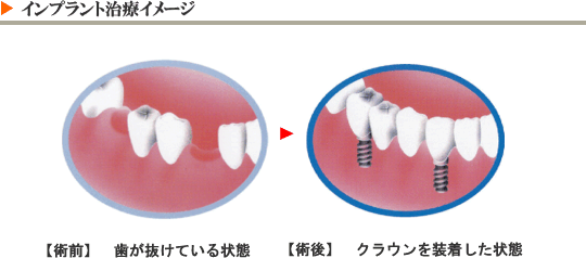 インプラント治療イメージ