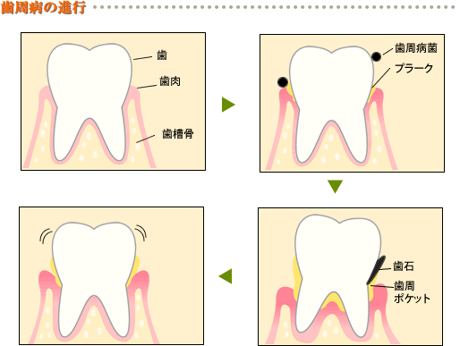 いわき市 いいの歯科 院内紹介 予防　歯周病の進行