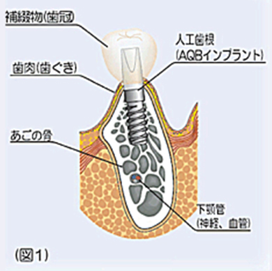 インプラントとは