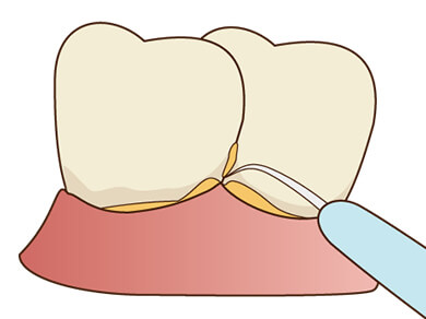 歯石の除去